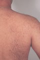 Permanent Back Hair Removal with Lasers