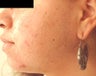 Lumenis Lightsheer Permanent Facial Laser Hair Removal