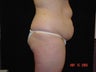 Extended Abdominoplasty