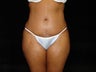 Standard Abdominoplasty