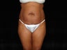 Standard Abdominoplasty