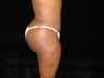 Standard Abdominoplasty