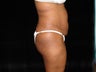 Standard Abdominoplasty