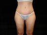 Extended Abdominoplasty