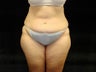 Extended Abdominoplasty