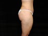 Extended Abdominoplasty