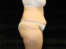 Extended Abdominoplasty