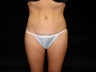 Standard Abdominoplasty