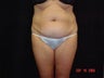 Standard Abdominoplasty