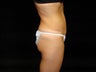 Standard Abdominoplasty