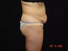 Standard Abdominoplasty
