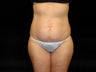 Standard Abdominoplasty