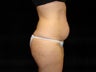Standard Abdominoplasty