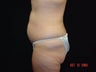 Standard Abdominoplasty