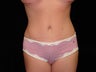 Standard Abdominoplasty