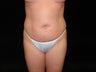 Standard Abdominoplasty