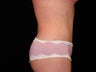 Standard Abdominoplasty