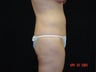 Body Lift with Liposuction of Abdomen, Waist, and Flanks