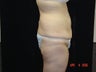 Body Lift with Liposuction of Abdomen, Waist, and Flanks