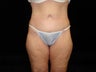Body Lift with Liposuction of Abdomen, Waist, and Flanks
