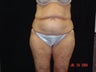 Body Lift with Liposuction of Abdomen, Waist, and Flanks