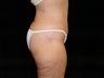 Body Lift with Liposuction of Abdomen, Waist, and Flanks