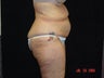 Body Lift with Liposuction of Abdomen, Waist, and Flanks