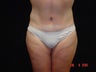 Body Lift with Liposuction of Abdomen, Waist, Flanks