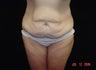 Body Lift with Liposuction of Abdomen, Waist, Flanks