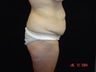 Body Lift with Liposuction of Abdomen, Waist, and Flanks