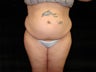 Liposuction of Abdomen, Waist, Flanks and Dorsal Roll