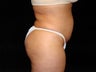 Liposuction of Abdomen, Waist, Flanks and Dorsal Roll