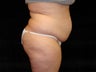 Liposuction of Abdomen, Waist, Flanks and Dorsal Roll