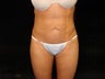 Liposuction of Abdomen, Waist, Flanks, and Inner/Outer Thighs