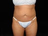 Liposuction of Abdomen, Waist, Flanks, and Inner/Outer Thighs