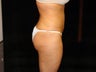 Liposuction of Abdomen, Waist, Flanks, and Inner/Outer Thighs