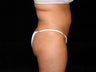 Liposuction of Abdomen, Waist, Flanks, and Inner/Outer Thighs
