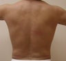 Liposuction love handles