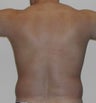 Liposuction love handles