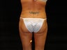 Liposuction of Abdomen, Waist, Flanks, and Inner/Outer Thighs