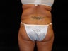 Liposuction of Abdomen, Waist, Flanks, and Inner/Outer Thighs