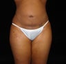 Liposuction Abdomen, Waist, Flanks and Dorsal Roll