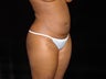 Liposuction of Abdomen, Waist, Flanks and Dorsal Roll