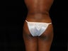 Liposuction of Abdomen, Waist, Flanks and Dorsal Roll