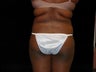 Liposuction of Abdomen, Waist, Flanks and Dorsal Roll