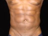 Liposuction of Abdomen, Waist, Flanks with 6 Pack Abdominal Etching