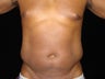 Liposuction of Abdomen, Waist, Flanks with 6 Pack Abdominal Etching