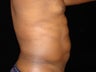 Liposuction of Abdomen, Waist, Flanks with 6 Pack Abdominal Etching