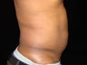Liposuction of Abdomen, Waist, Flanks with 6 Pack Abdominal Etching
