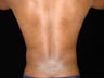 Liposuction of Abdomen, Waist, Flanks with 6 Pack Abdominal Etching